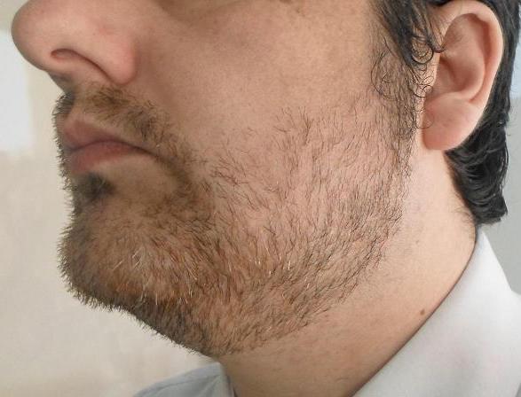 Transplante de barba