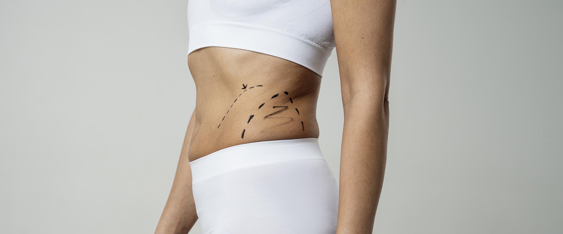 Liposuction