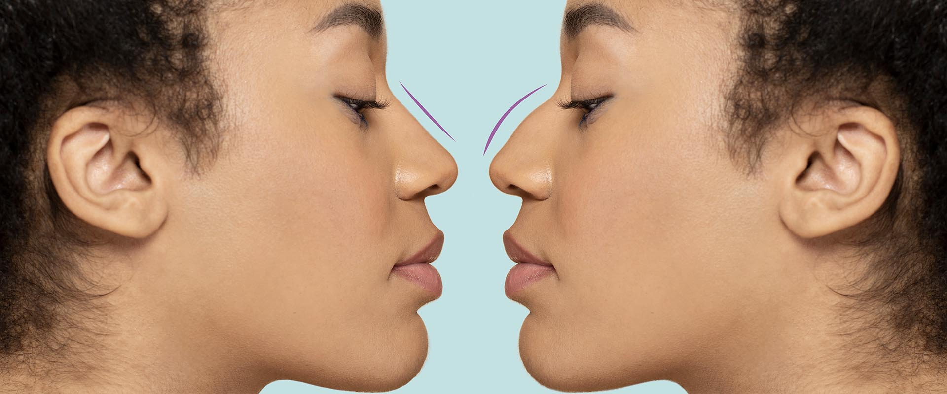 Rhinoplasty