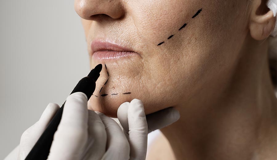 Chin augmentation