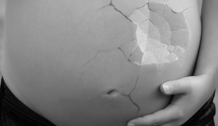 ▷ ¿Embarazo después de una abdominoplastia? ⭐️ Descúbrelo AQUÍ